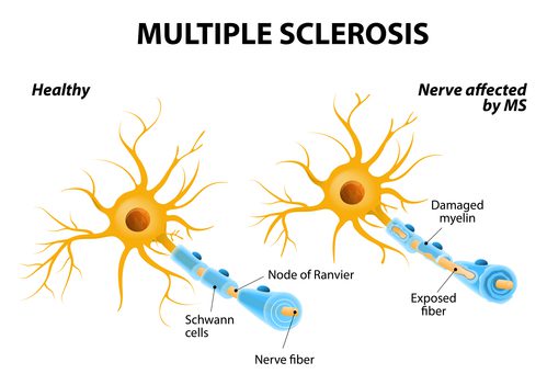 Yoga and Multiple Sclerosis