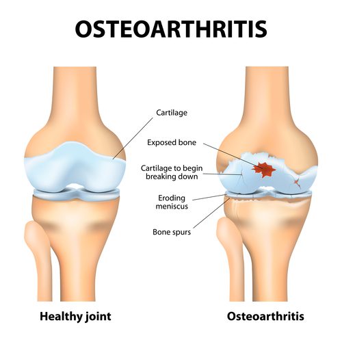 Yoga for Arthritis